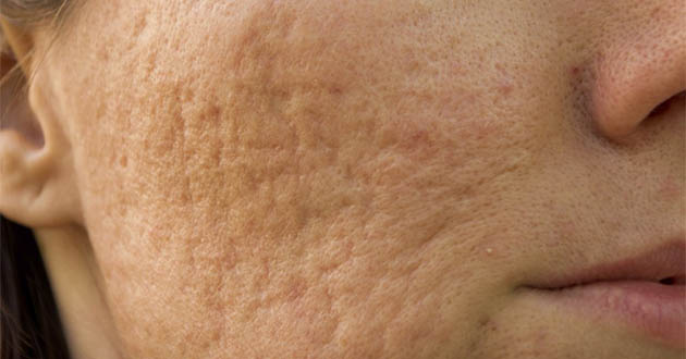 chikenpox scar