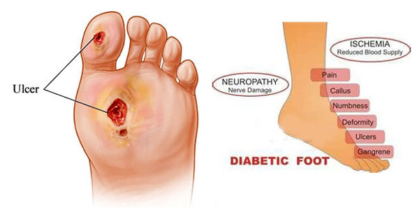 foot care of diabetics