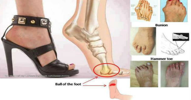 harmfulness of using high heel