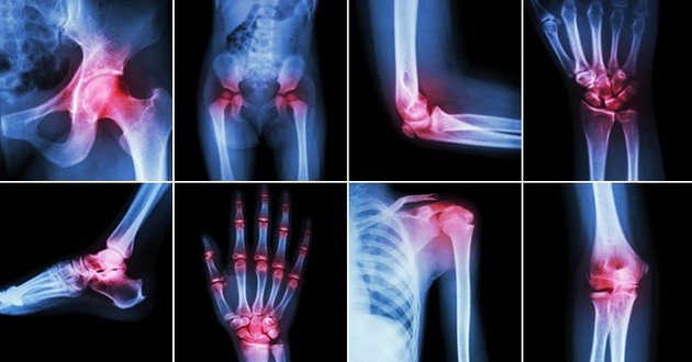 arthritis pain