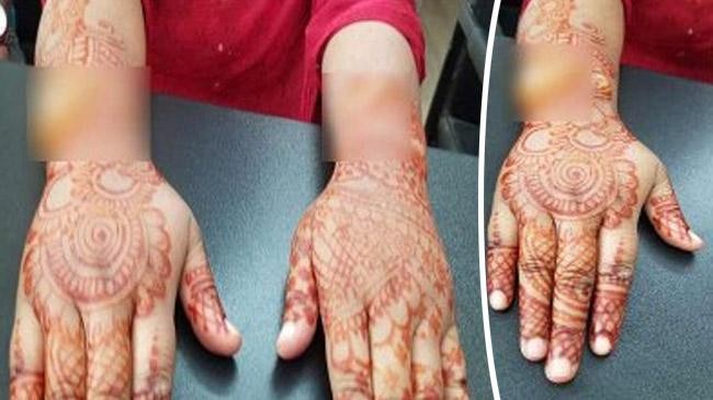 blisters on hands after applying henna