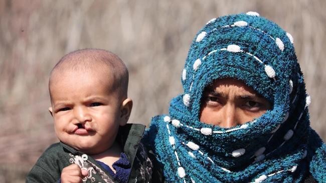 children with clefts
