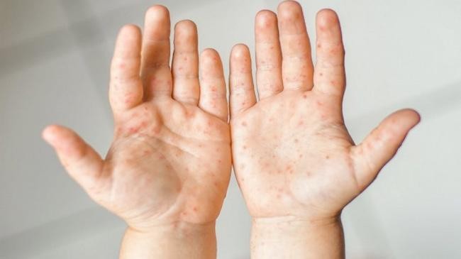 hand foot and mouth disease