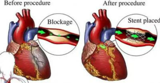 heart ring