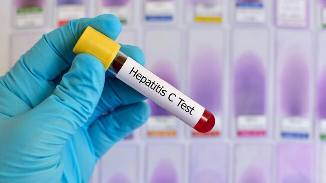 heptitis test file photo