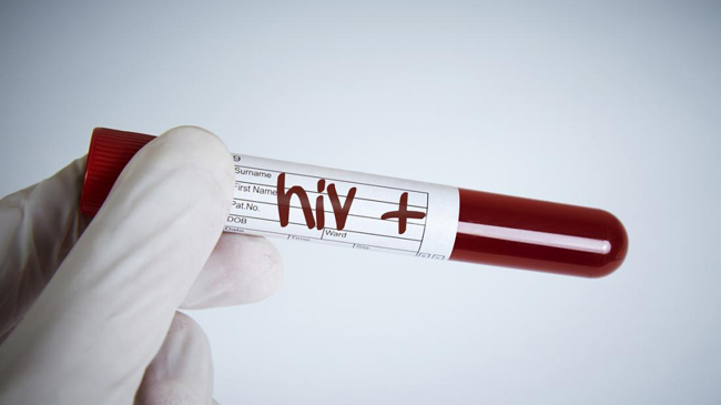hiv aids