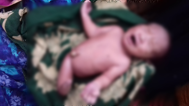 one leg baby born