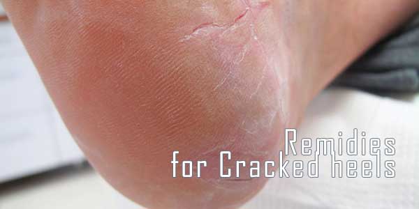 remidies for cracked heels