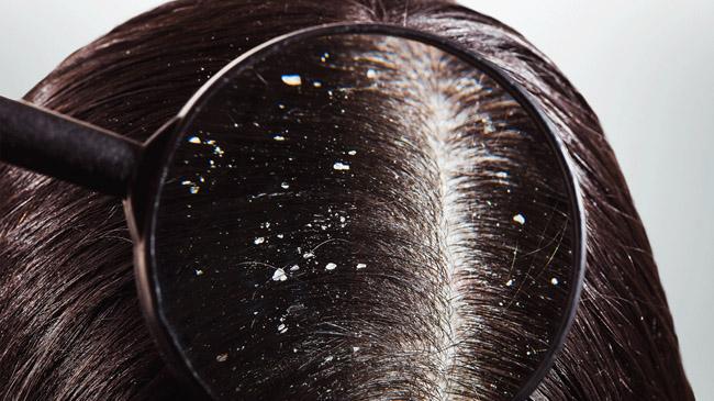 six ways to remove dandruff