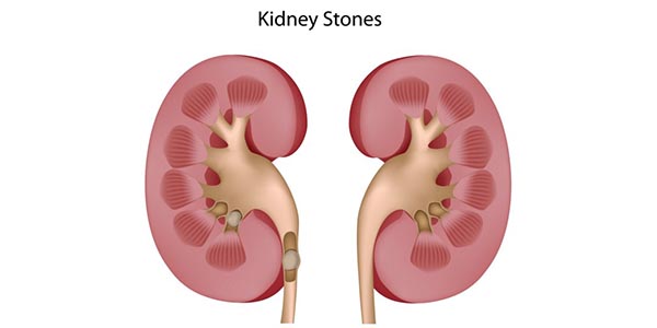 Kidney stone problem