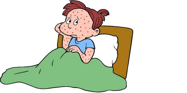 chicken pox