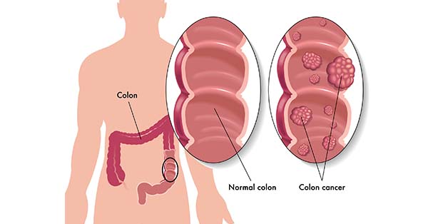 colon cancer