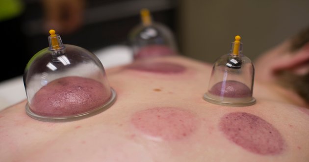 cupping therapy