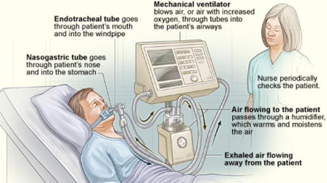 cv patient ventilator