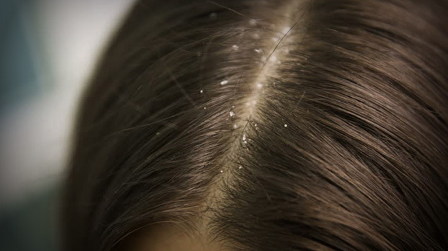 dandruff women