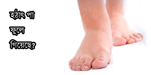 edema home remedies