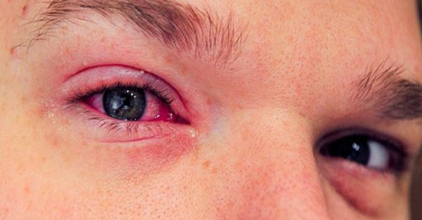 eye infection