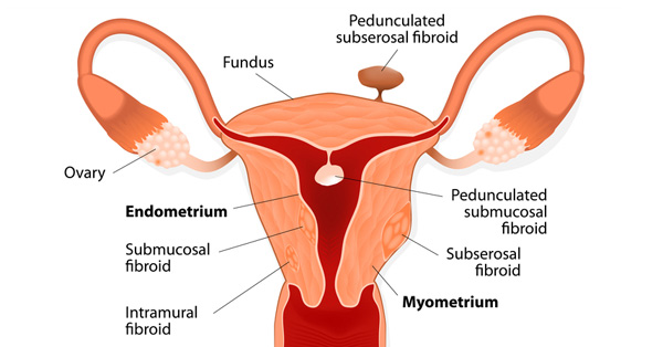 fibroid tumor