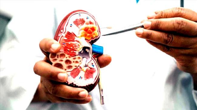 kidney stone symptoms2