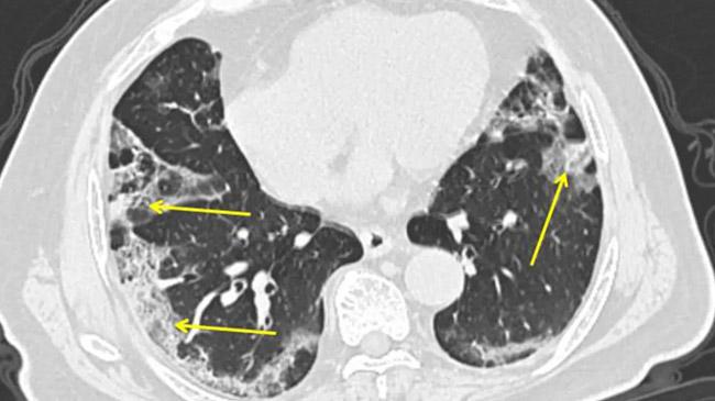 what happens to people lungs when they get infected