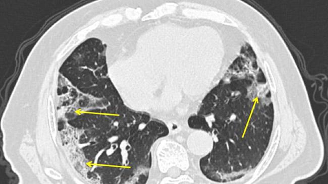 lungs damage after contacted