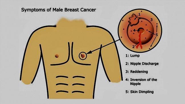 aware of breast cancer