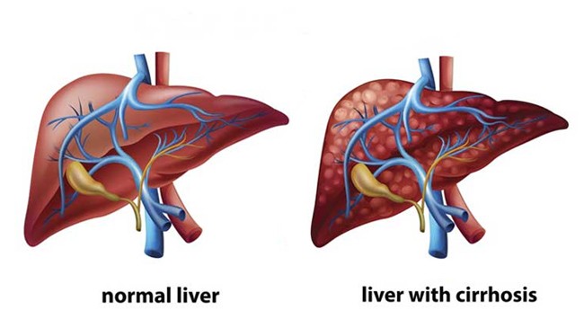 normal liver liver cirrhosis