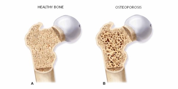 osteoporosis