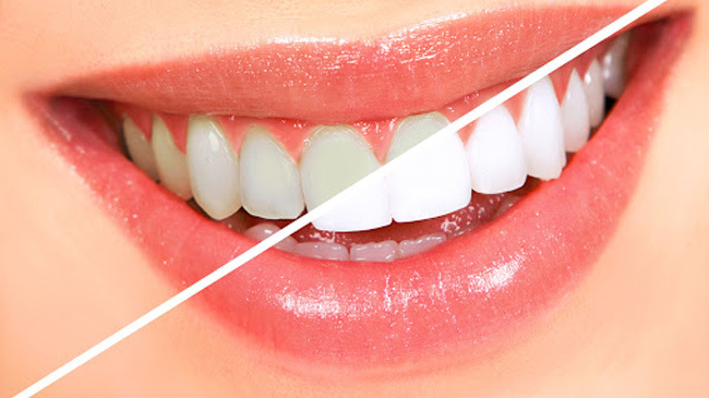 teeth whitening