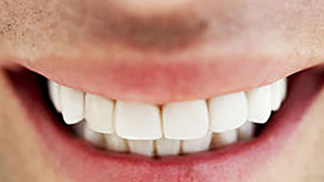 teeth whitening 1