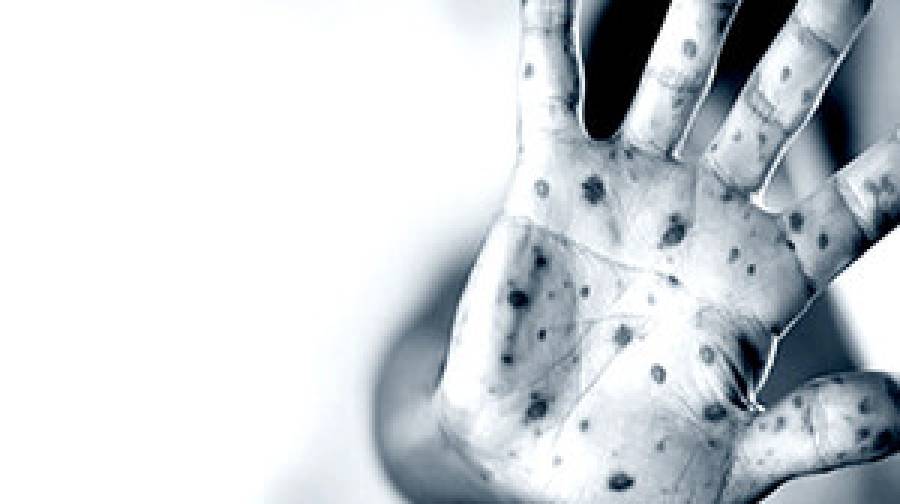 হামের প্রাদুর্ভাব বাড়ছে, ২৪ ঘণ্টায় উপসর্গে ১১ শিশুর মৃত্যু