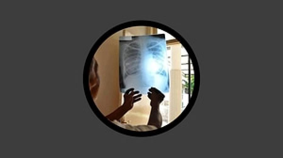 প্লাটোতে যক্ষ্মার প্রকোপ: আক্রান্তের সংখ্যা ১১ হাজার