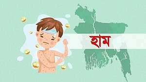 দেশে হাম ও উপসর্গে আরও ১২ শিশুর মৃত্যু