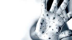 দুই জেলায় হামের প্রকোপ: এক দিনে ভর্তি ২৮ শিশু