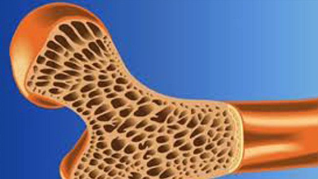 artificial bone