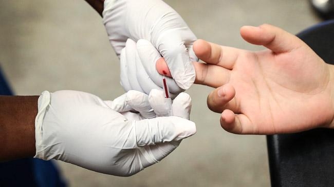 hiv super strain found netherland