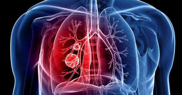 lung cancer