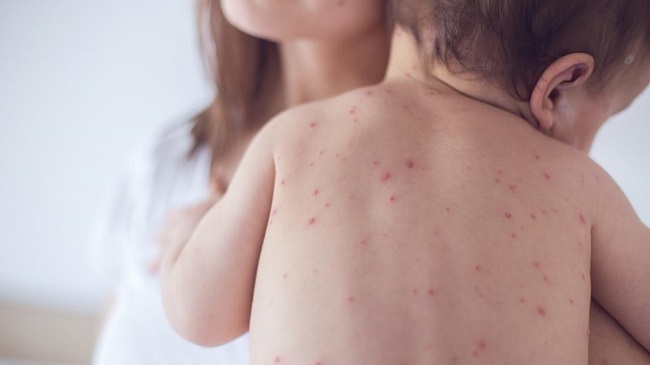 measles spot