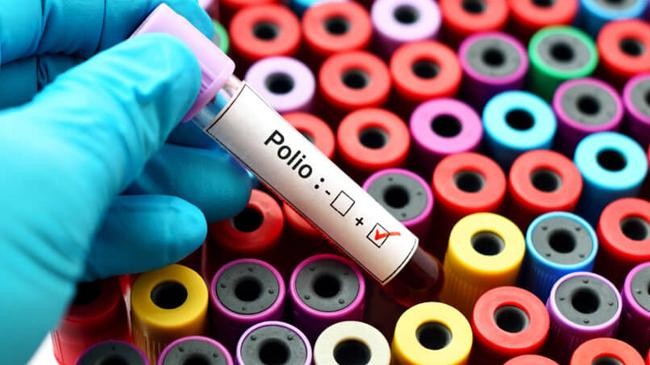 polio positive