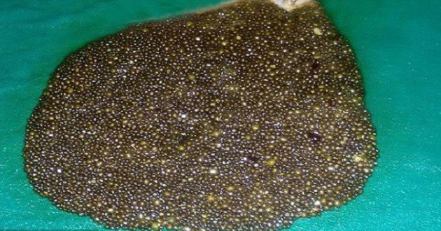 stone in stomach