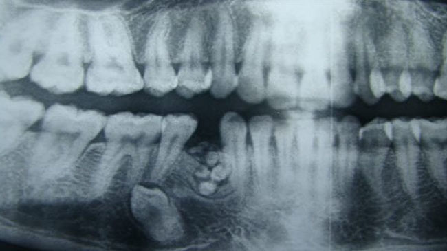 teeth india