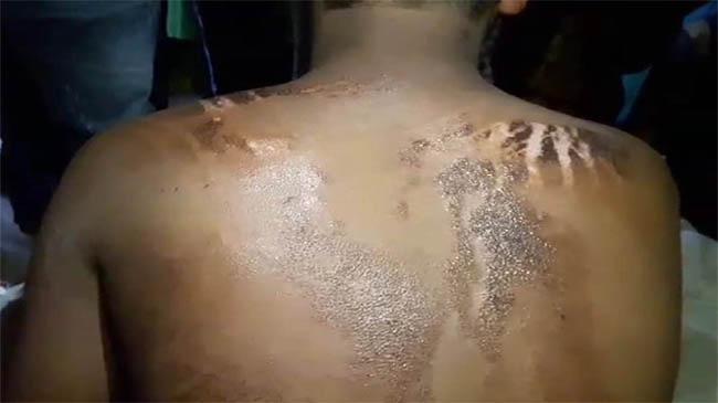 throwing acid india